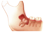 Demonstração de cirurgia dos dentes inclusos / dente do siso