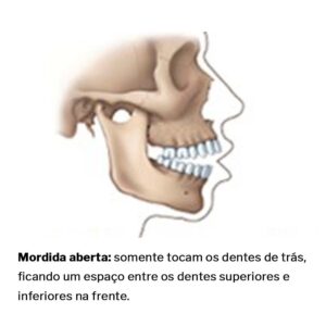 Mordida-aberta-cirurgia-ortognatica-02