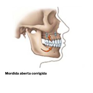 Mordida-aberta-cirurgia-ortognatica-03