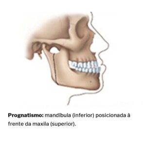 Prognatismo-cirurgia-ortognatica-01