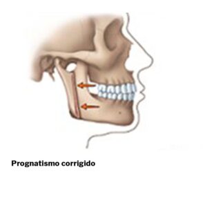 Prognatismo-cirurgia-ortognatica-02