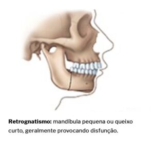 Retrognatismo-cirurgia-ortognatica-01