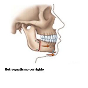 Retrognatismo-cirurgia-ortognatica-02